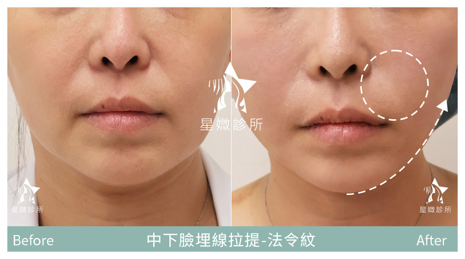 星媺診所-藍鑽魚骨線案例-法令紋