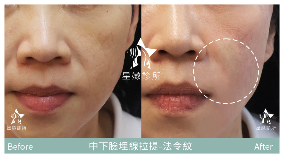 星媺診所-藍鑽魚骨線案例-法令紋拉提