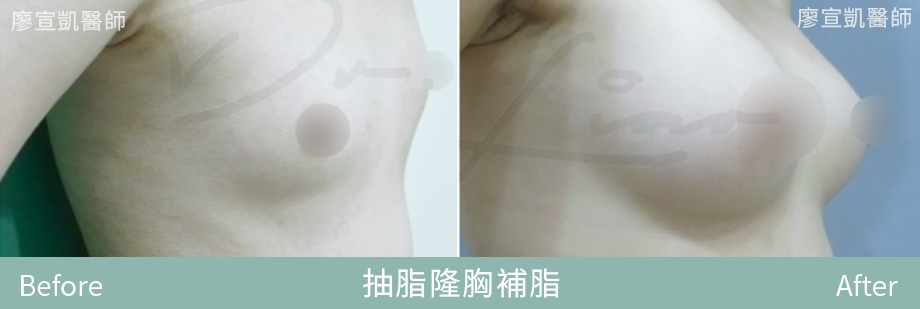 02-廖宣凱醫師抽脂隆胸補脂整形外科-星媺診所