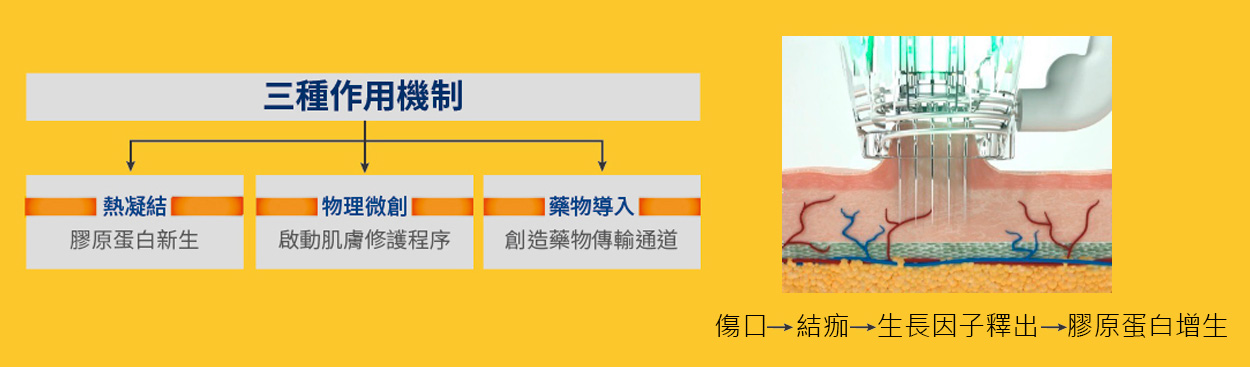 閃電微針 閃電音波-星媺診所