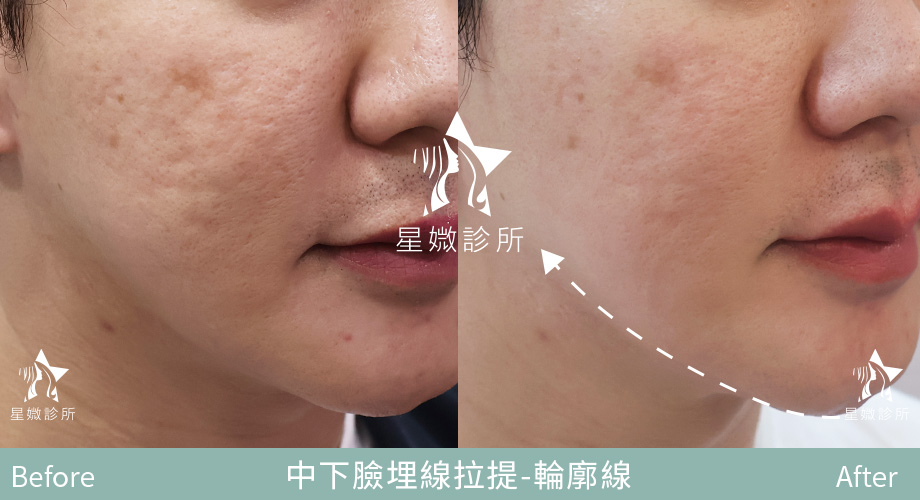 藍鑽魚骨線-星媺案例