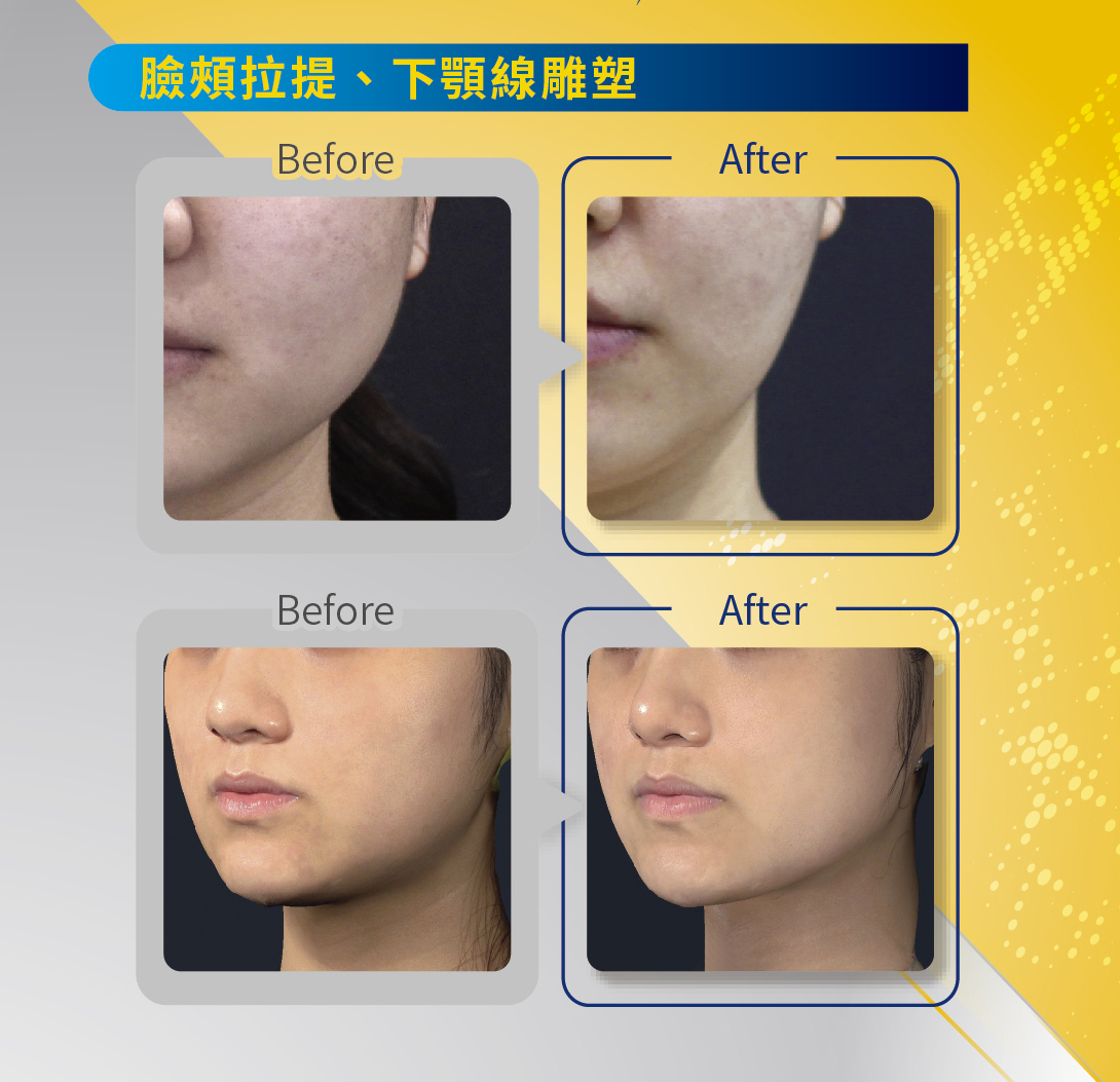 閃電音波原廠案例-星媺診所