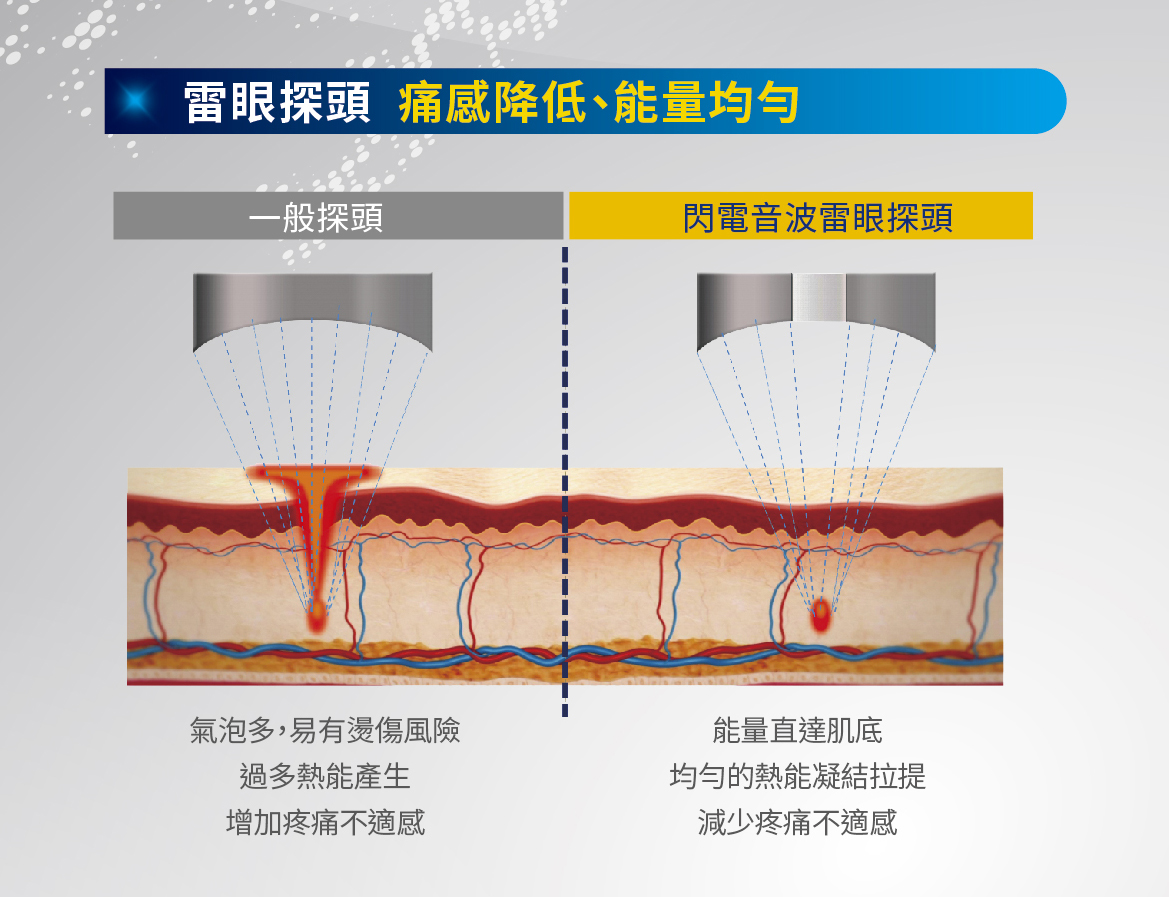 閃電微針 閃電音波-星媺診所