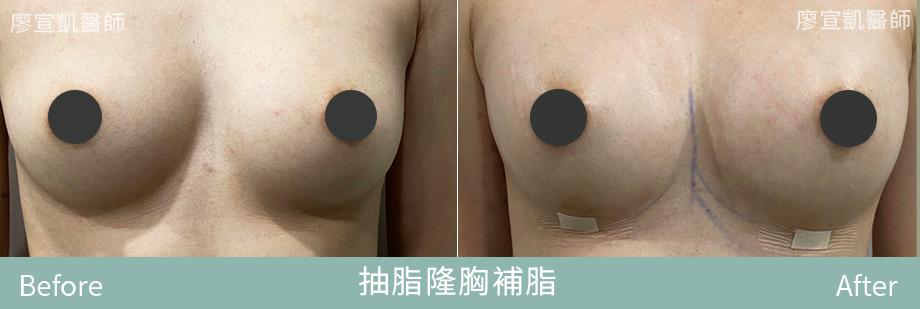 06-廖宣凱醫師抽脂隆胸補脂整形外科-星媺診所