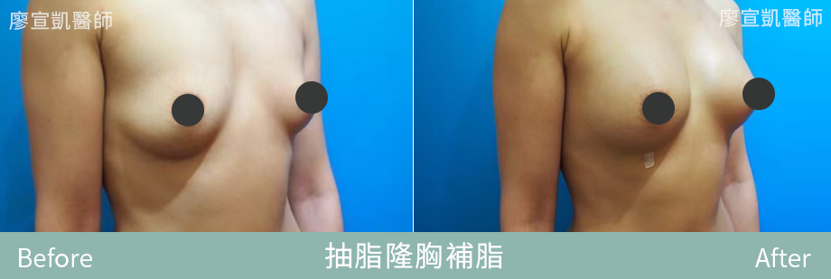 04-廖宣凱醫師抽脂隆胸補脂整形外科-星媺診所