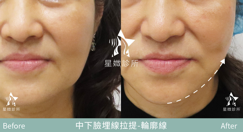 藍鑽魚骨線-星媺案例