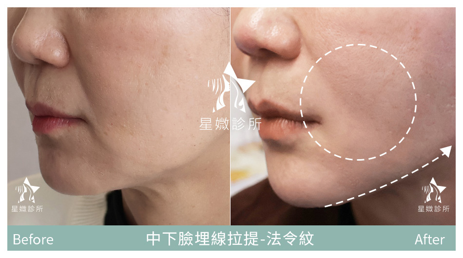 星媺診所-藍鑽魚骨線案例-法令紋