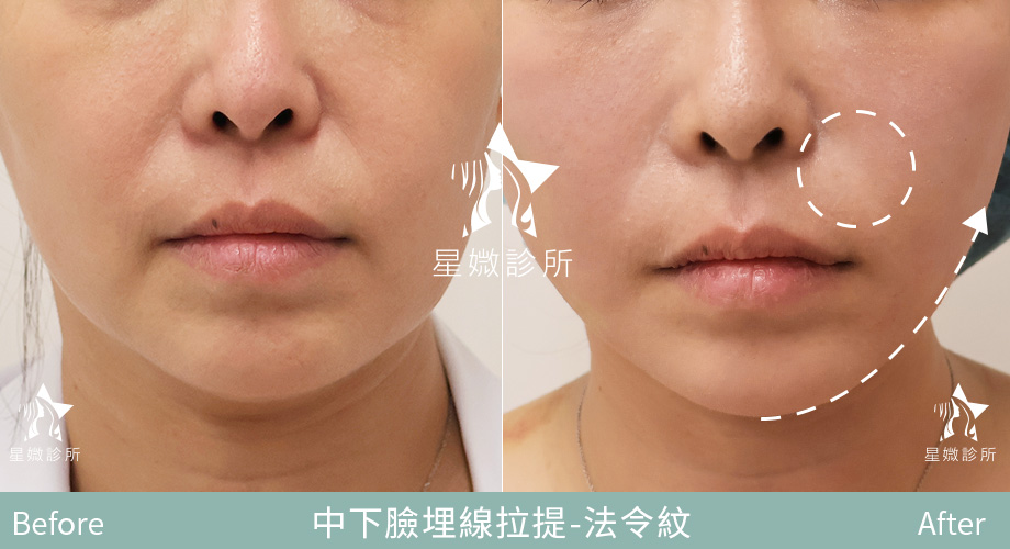 藍鑽魚骨線-星媺案例