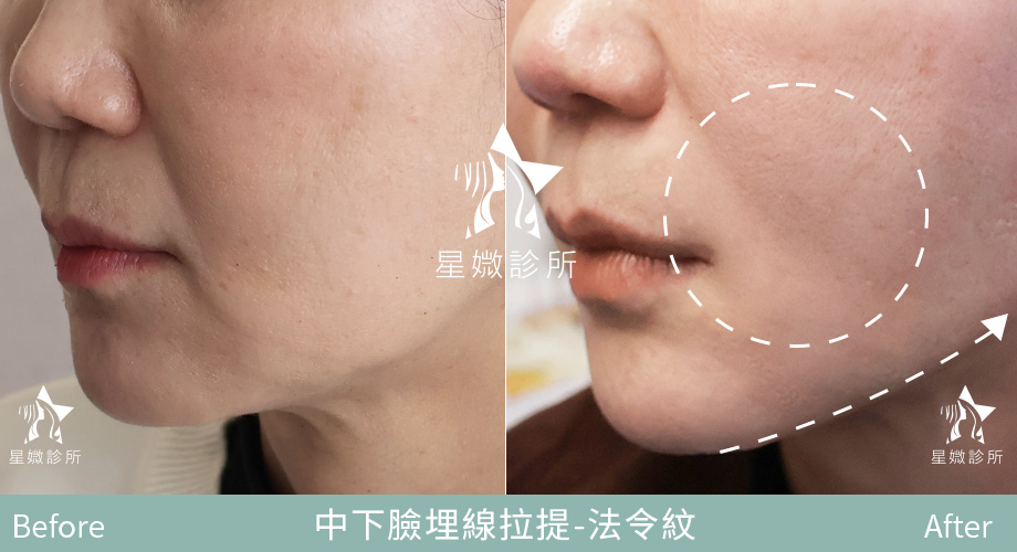 藍鑽魚骨線-星媺案例