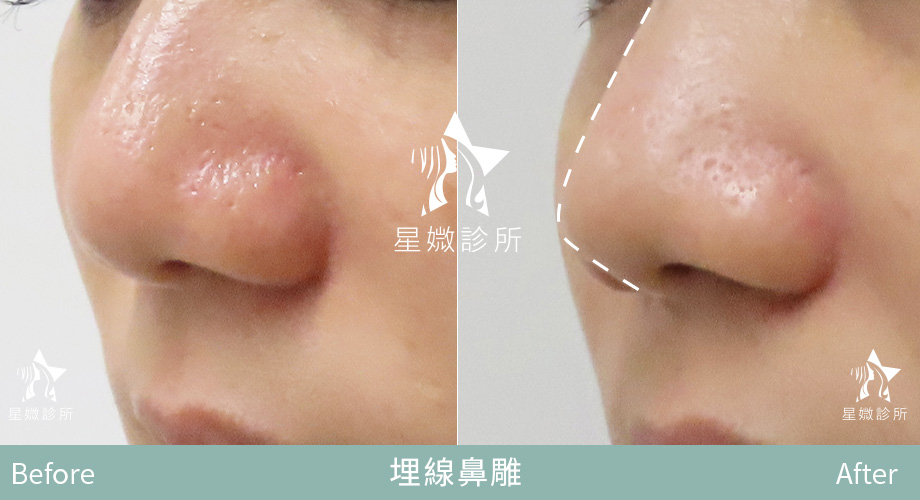 藍鑽魚骨線-星媺案例