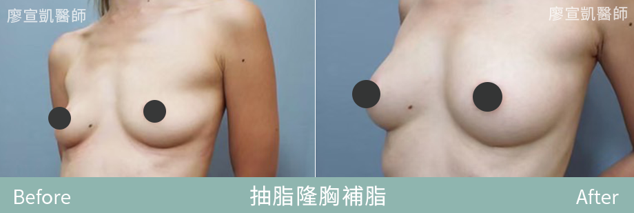 05-廖宣凱醫師抽脂隆胸補脂整形外科-星媺診所