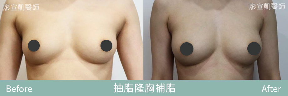 01-廖宣凱醫師抽脂隆胸補脂整形外科-星媺診所