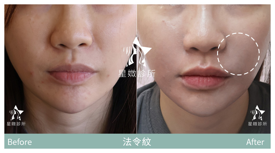 星媺診所-玻尿酸案例-法令紋