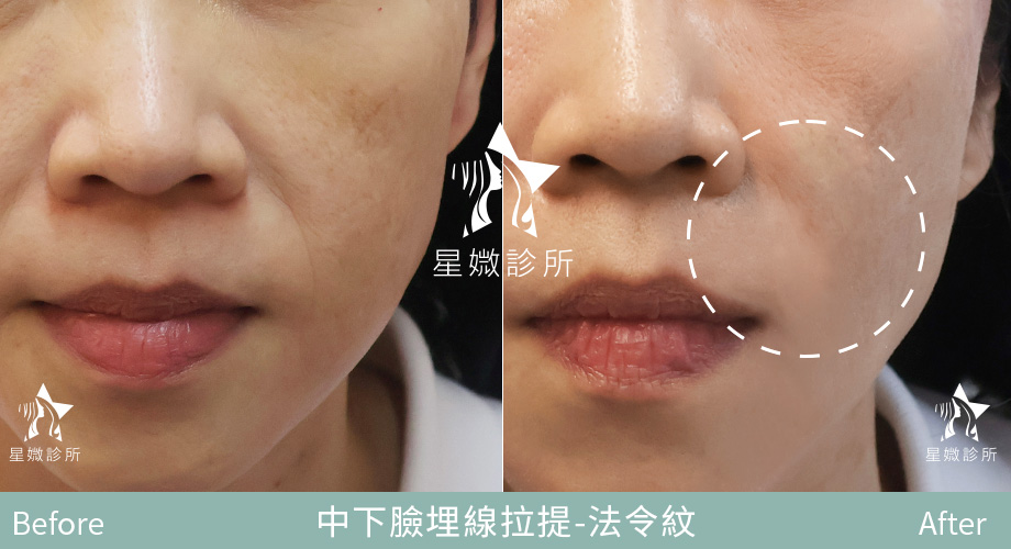 藍鑽魚骨線-星媺案例