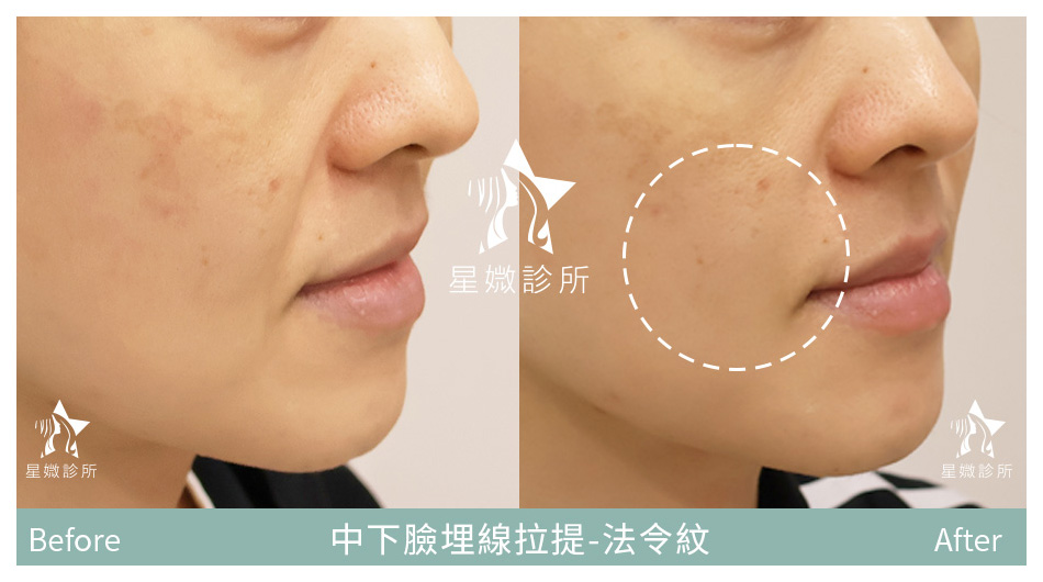 星媺診所-藍鑽魚骨線案例-法令紋