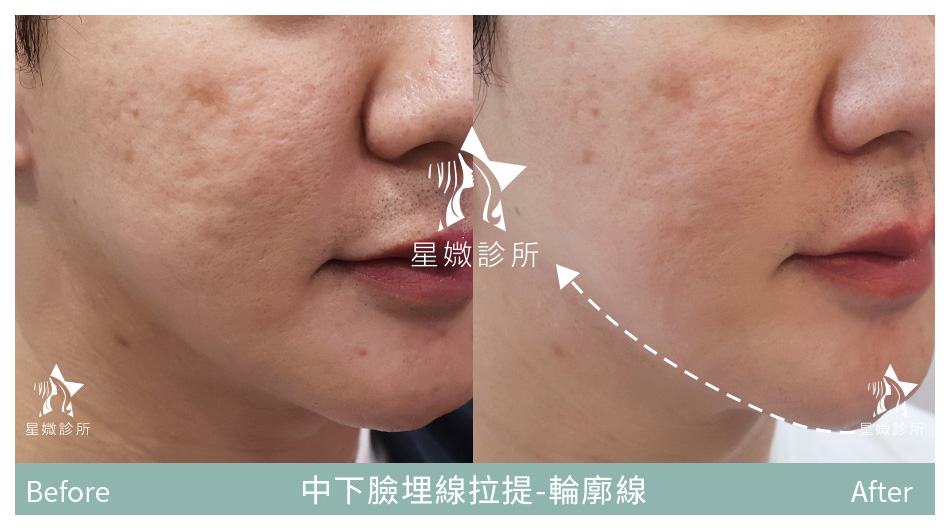 星媺診所-藍鑽魚骨線案例-下顎線